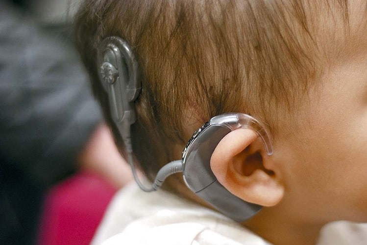 Cochlear Implant Mapping